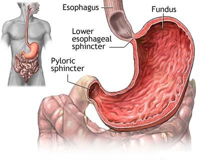 Cancerul gastric